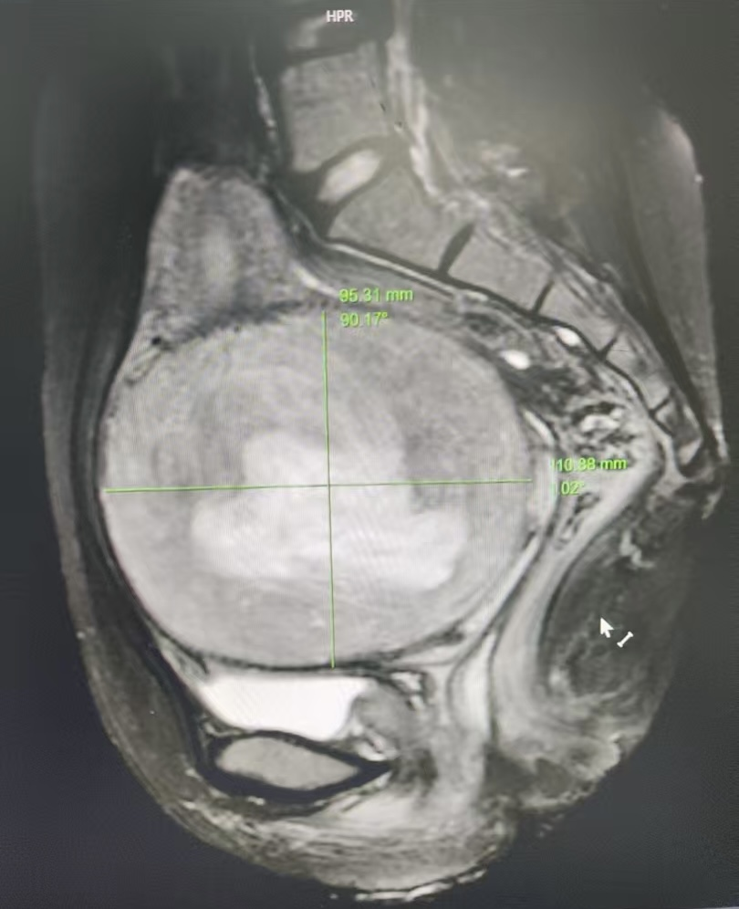 【子宫肌瘤】精准治疗很重要!