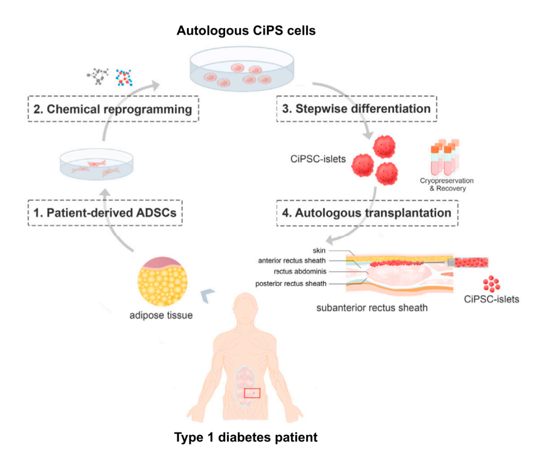 行业前沿丨新华社：100%脱离胰岛素，我国创世界首例CiPSC干细胞功能性治愈1型糖尿病！