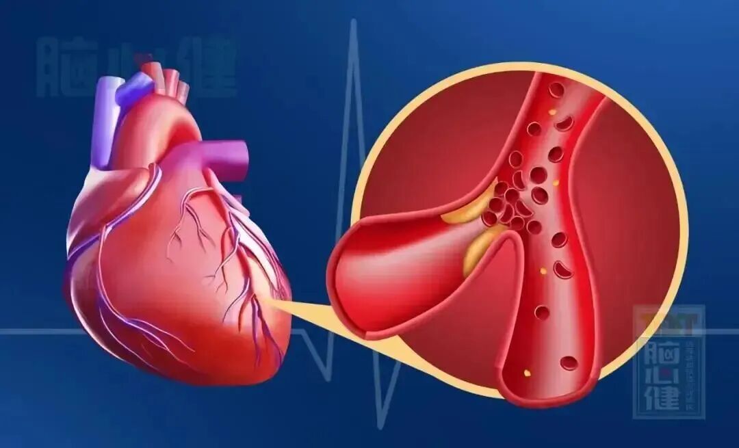 细胞科普|心梗6小时可导致10亿心肌细胞死亡，干细胞治疗可实现新心肌组织生成以逆转心衰