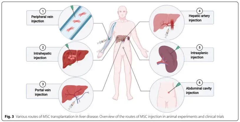 细胞科普|700例肝硬化患者接受干细胞治疗，3个关键机制让肝功能逆转！